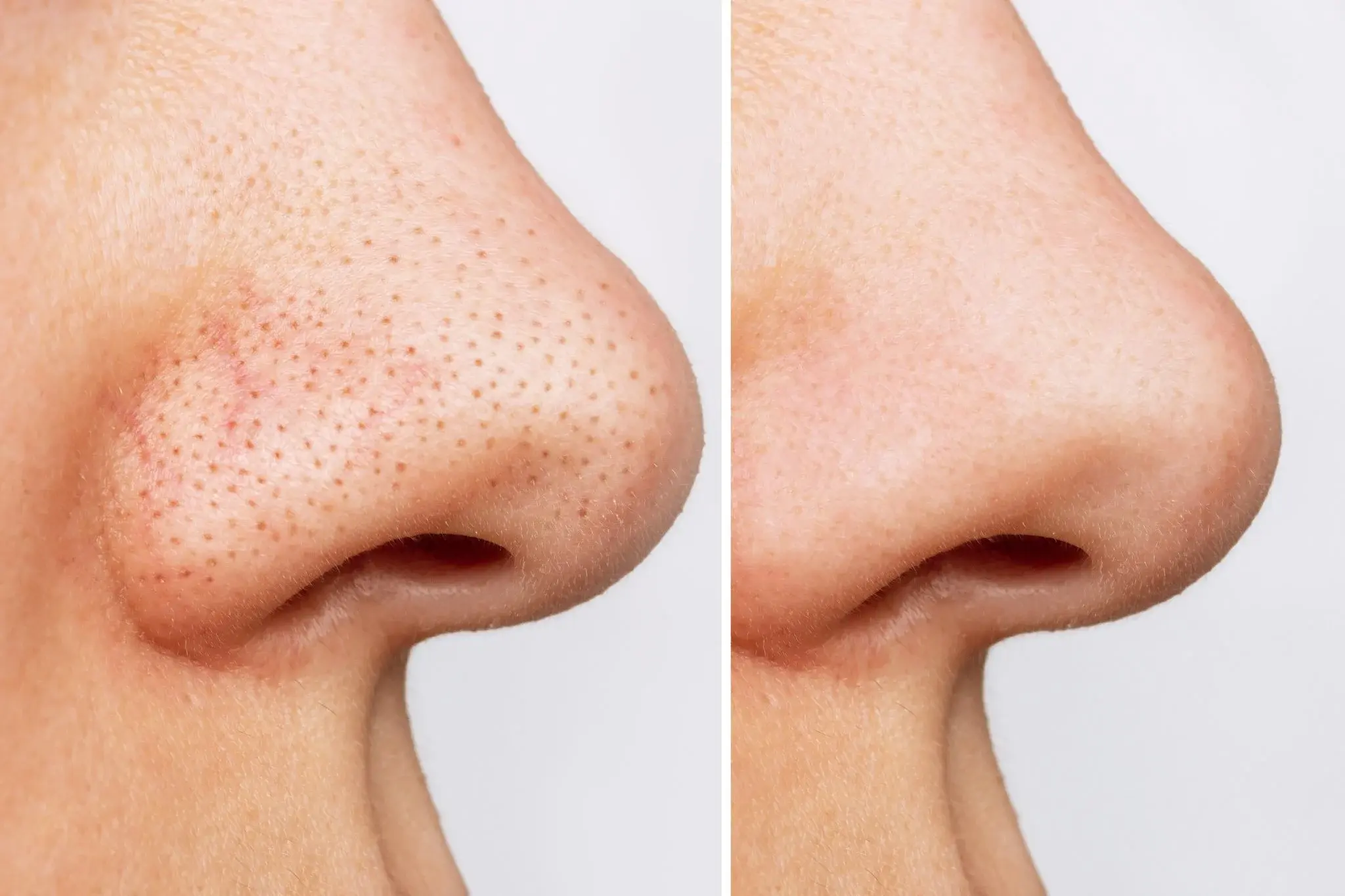How to Get Rid of Blackheads? Blackhead Removal Tips image